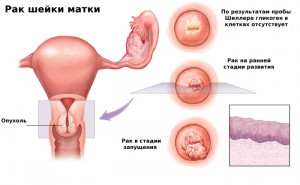 tservitsit-shejki-matki-simptomy-lechenie-kak-lechit-pri-beremennosti