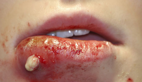 mrsa-staph-infection