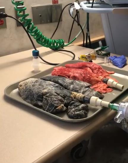 Медсестра объясняет, что ежедневное курение делает с легкими