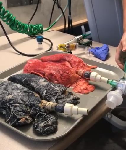 Медсестра объясняет, что ежедневное курение делает с легкими