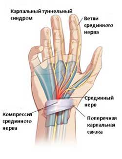 Туннельный синдром запястья— профилактика и лечение